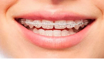 (P) Ai nevoie de un aparat dentar? Informează-te înainte!