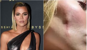 Khloé Kardashian, fotografie tulburătoare din lupta sa cu cancerul! Vedeta și-a îndepărtat tumora de la nivelul feței: „Mi-au schimbat chipul”. Cum arată acum