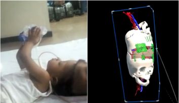 Gemene siameze cu craniile lipite, separate cu succes prin intervenții asistate de Inteligența Artificială. Cum arată acum fetele în vârstă de trei ani
