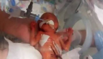 Nascuta prematur, atat de devreme incat i se observa creierul prin pielea capului. Povestea emotionanta a micutei Hailie