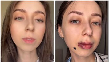 O influenceriță a povestit cum i s-a schimbat înfățișarea după ce și-a pus acid în buze. S-a trezit cu buzele învinețite după intervenție