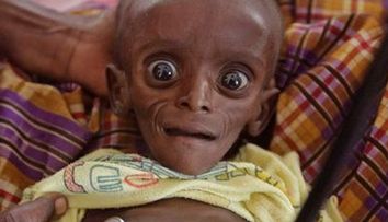 Imaginea zilei: Un bebelus subnutrit din Kenya  