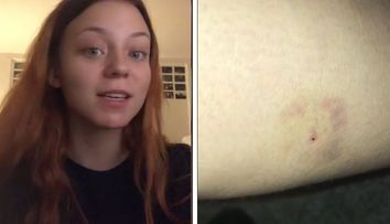 A petrecut seara într-un bar, iar a doua zi a descopeit că are o înțepătură de ac în picior. Ce i-au spus medicii