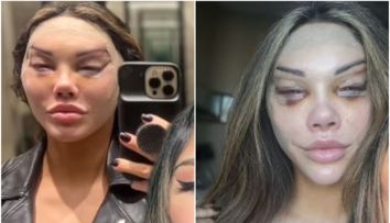 S-a operat ca să își facă “ochi de pisică” și a trecut prin chinuri groaznice: “Arătam ca un cadavru
