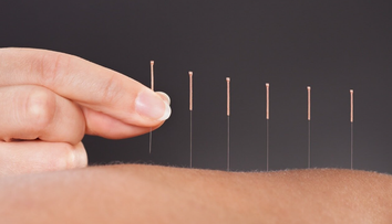 (P) Beneficiile acupuncturii