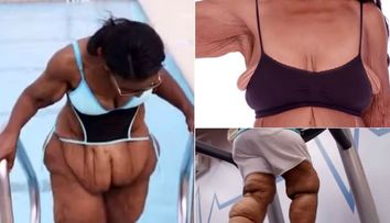 Surplusul de piele o facea sa regrete ca a slabit peste 90 de kilograme. Operatia care a urmat i-a schimbat viata