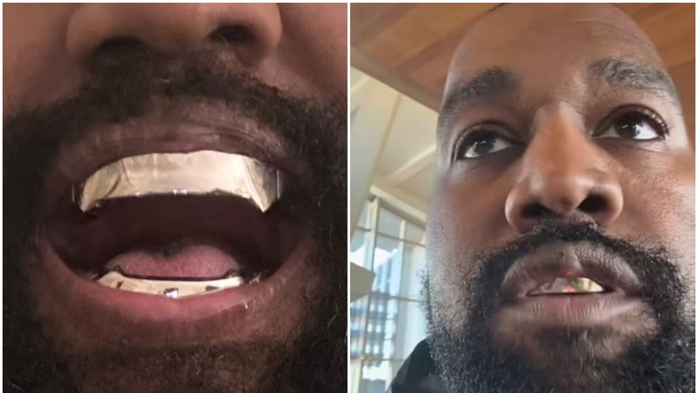Lui Kanye i-a “crescut” ceva pe față, iar fanii sunt alarmați. Cum explică medicii umflătura de pe buza rapperului