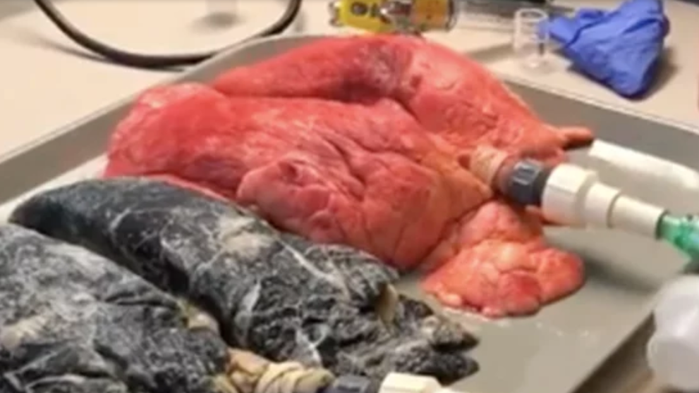 Imagini socante arata diferenta dintre plamanii unui fumator si al unui nefumator