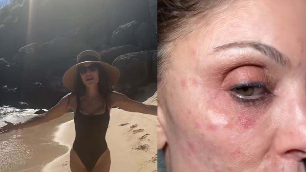 Și-a distrus fața din cauza unui prosop de la hotel! Cum s-a postat o antreprenoare de top după ce a făcut o infecție bacteriană pe față, în timp ce era în vacanță: „Nu le folosiți niciodată!”