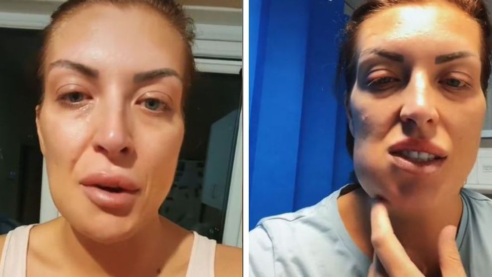 O femeie a mers în Turcia pentru a obține un zâmbet de Hollywood, însă s-a ales cu fața mutilată