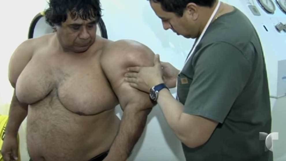Cazul uluitor al barbatului care facea scufundari si s-a umflat tot cand a iesit din apa!
