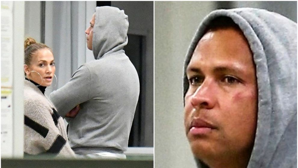 Alex Rodriguez, cu ochiul vânăt la câteva zile după ce a fost acuzat de infidelitate. J Lo, ce i-ai făcut?