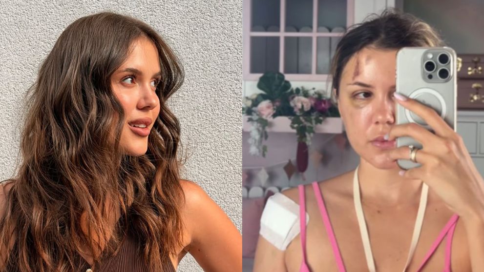 Prima reacție a lui Emily Burghelea după ce a fost acuzată că a înscenat accidentul din Mauritius. Vedeta a răbufnit: „Am purtat săptămâni întregi o atelă metalică în cap”