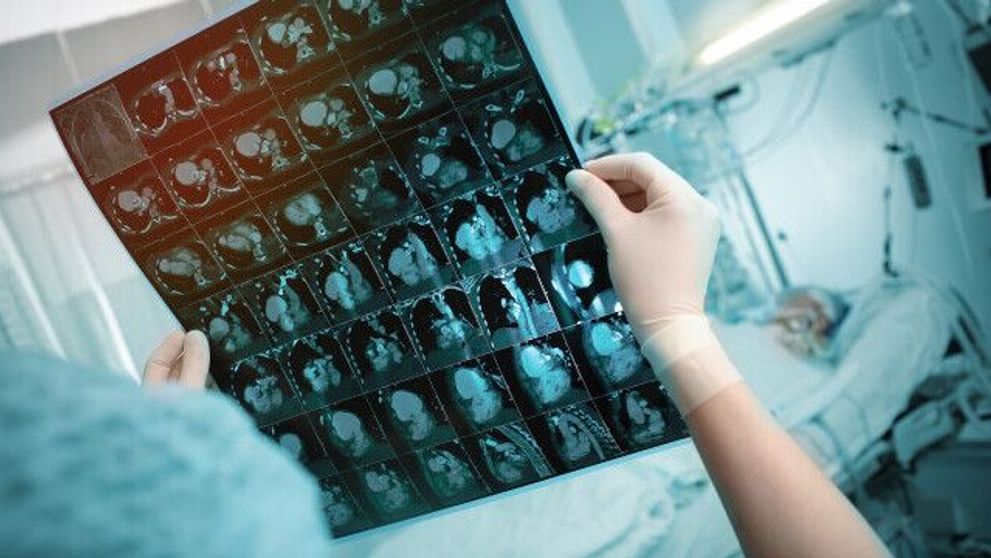 (P) Efecte pe termen lung ale COVID-19. De ce unii oameni au simptome persistente, chiar și după ce au trecut prin boală?