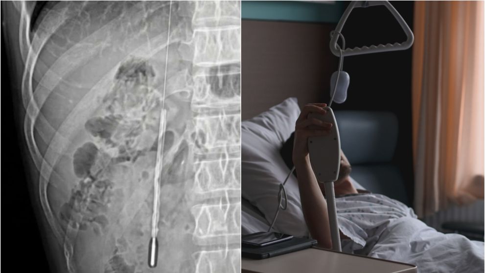 Caz absolut halucinant! Un tânăr, ajuns de urgență la spital cu dureri abdominale, avea de 20 de ani un obiect în stomac! Ce i-au descoperit medicii