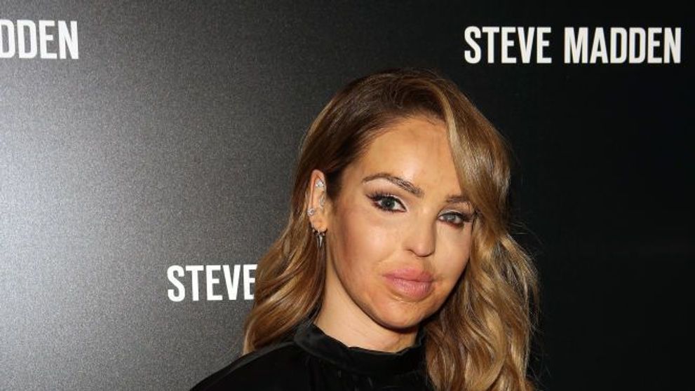 Katie Piper, complicații la 12 ani după ce a fost desfigurată cu acid sulfuric. De ce s-a operat iar