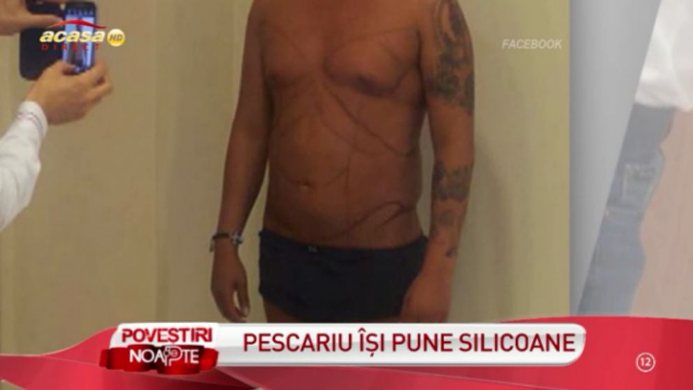 EL este primul barbat din Romania care si-a pus SILICOANE. Cum arata acum