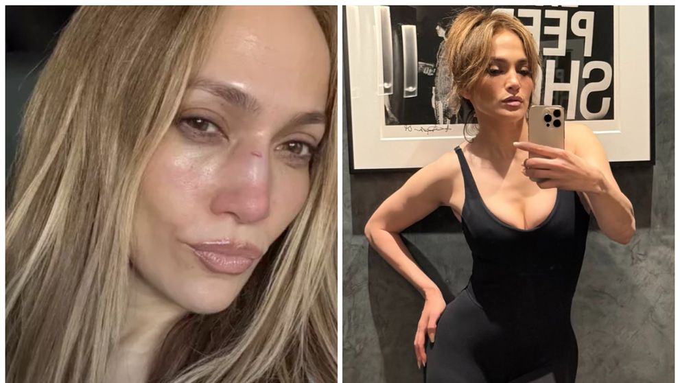 Imagini șocante cu Jennifer Lopez rănită pe față. Ce a declarat artista
