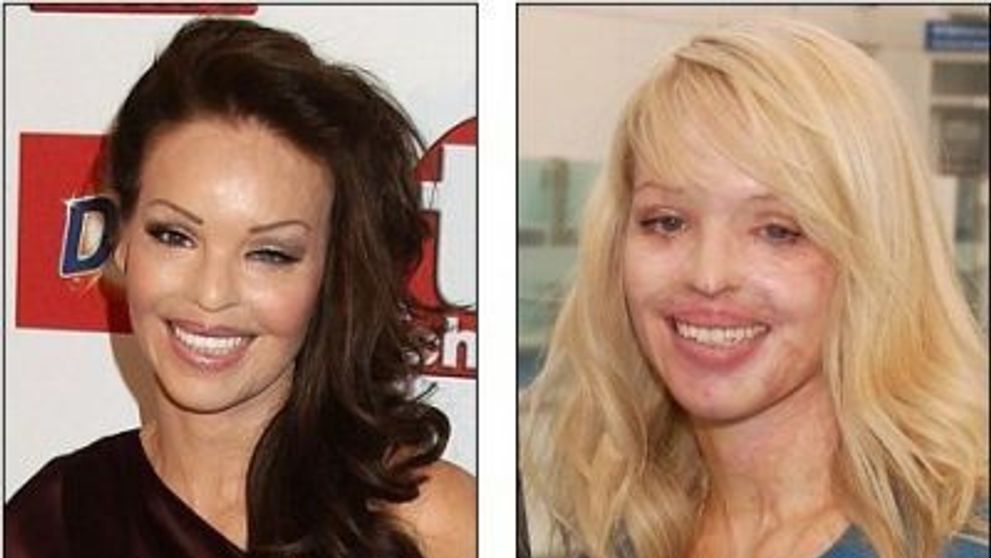 Katie Piper redevine o tanara incantatoare, dupa ce a fost violata si arsa cu acid sulfuric de fostul prieten - FOTO