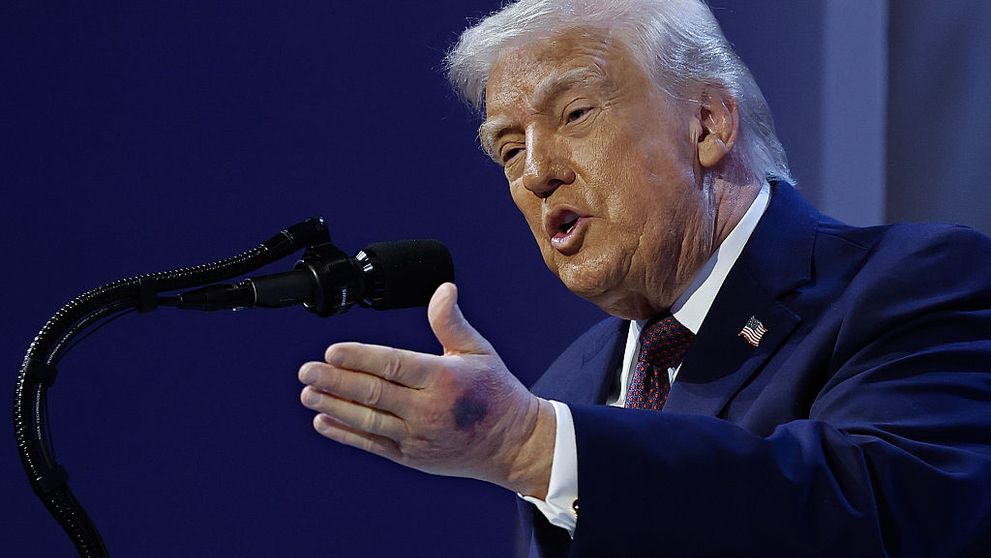 De ce are Donald Trump vânătăi pe mâini. Explicația din noul raport medical