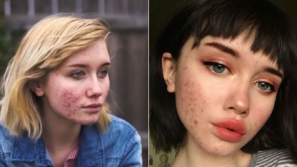 O adolescenta a inspirat tineri din intreaga lume cu povestea ei. Cum a reusit sa isi infrunte problemele cu acneea