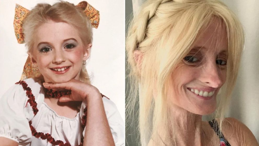 Cum arată la 48 de ani o femeie diagnosticată cu progeria. Medicii îi dădeau doar 12 ani de viață