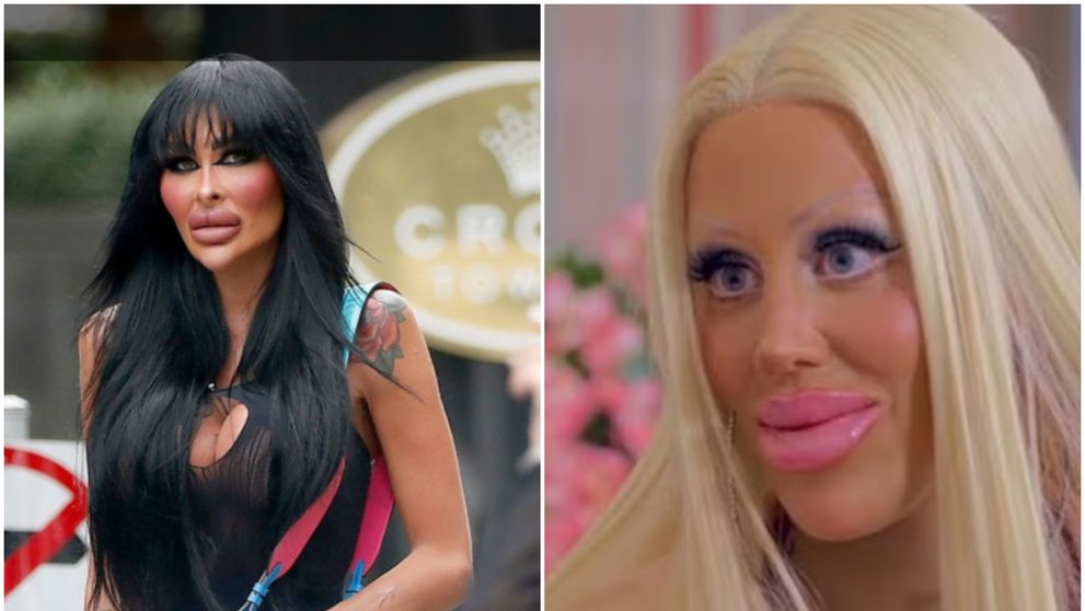 Operații până la moarte! Influencerii obsedați de operații estetice, care își riscă viața la fiecare nouă intervenție