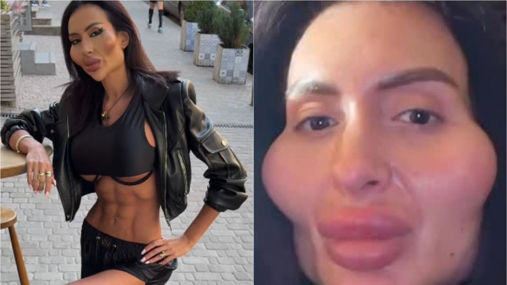 Acum deține recordul pentru cei mai mari pomeți din lume, dar în trecut era superbă! Cum arăta Anastasia Pokreshchuk înainte ca operațiile estetice să-i mutileze fața