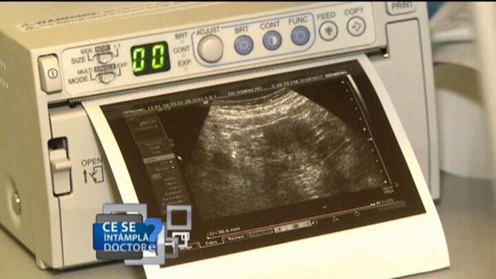Afla ce trebuie sa faci pentru a preveni cancerul la san!