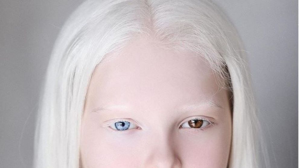 Amina, fetița cu albinism de o frumuseţe nepământeană uimește întreaga lume. A fost descoperită de o fotografă