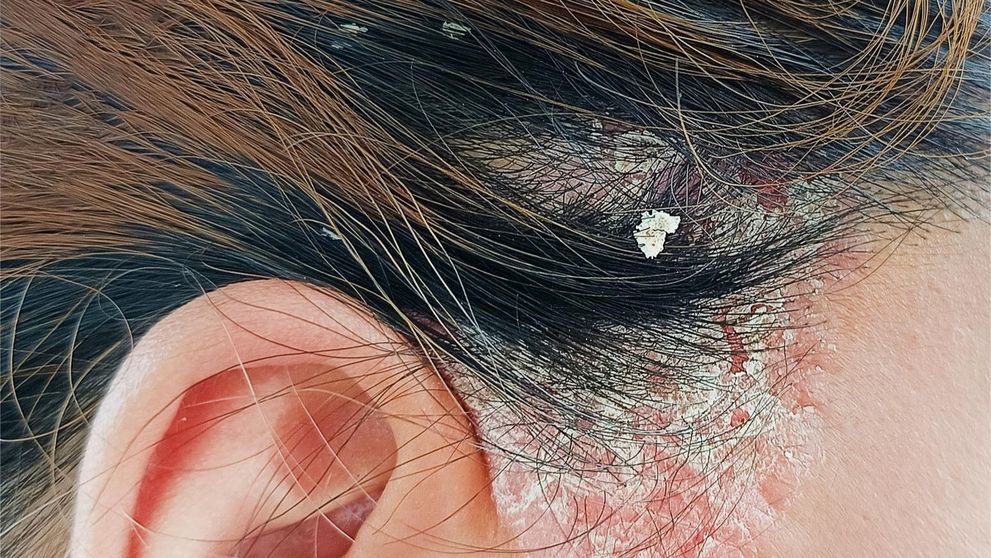 (P) Cum deosebim și tratăm: Psoriazis, Dermatită Seboreică, Mătreață și Scalp Uscat?