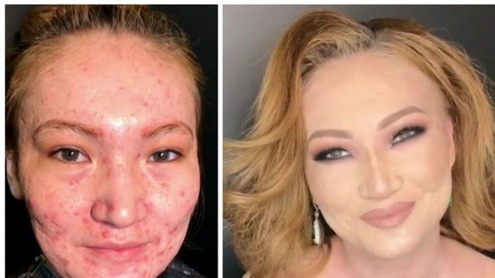 Transformare incredibila. Ea este make-up artistul magician, care face ca acneea severa sa dispara ca prin minune