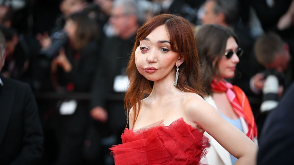 În ciuda diformității faciale, Nikki Lilly face senzație pe covorul roșu și pe catwalk. Care este afecțiunea teribilă de care suferă vedeta