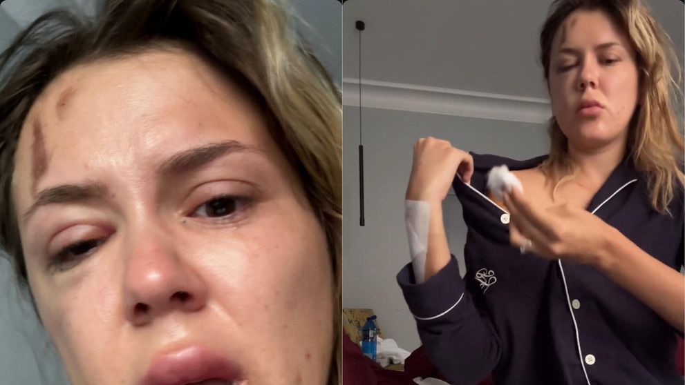 Emily Burghelea și-a șocat fanii. A apărut pe internet cu fața umflată și cu vânătăi pe corp