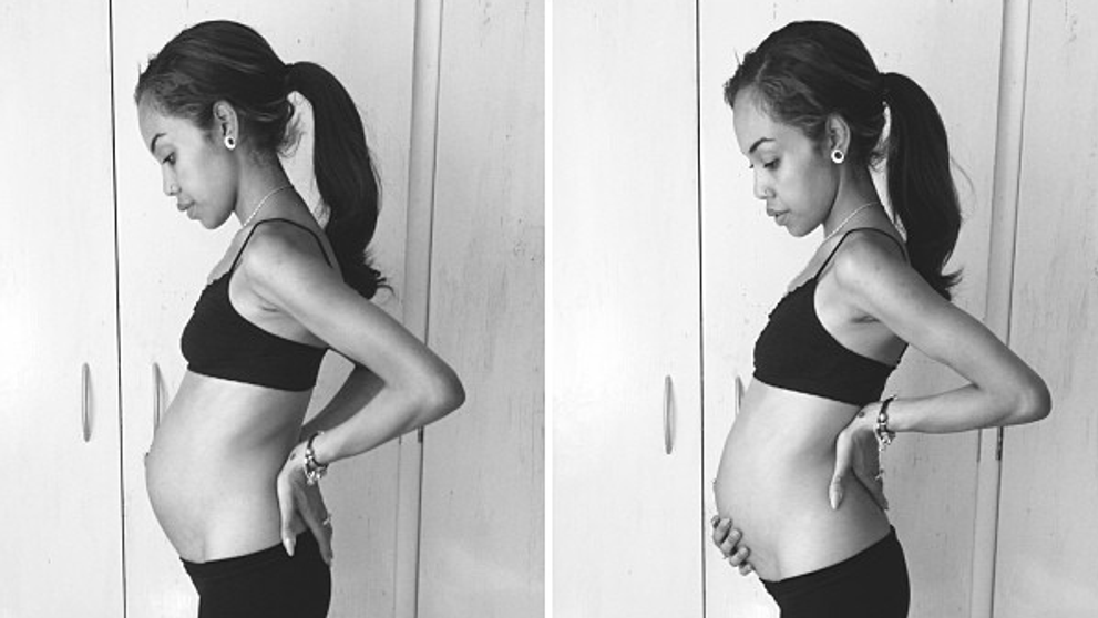 Insarcinata si anorexica. A nascut un copil perfect sanatos, desi in luna a opta de sarcina cantarea doar 51 de kilograme: FOTO