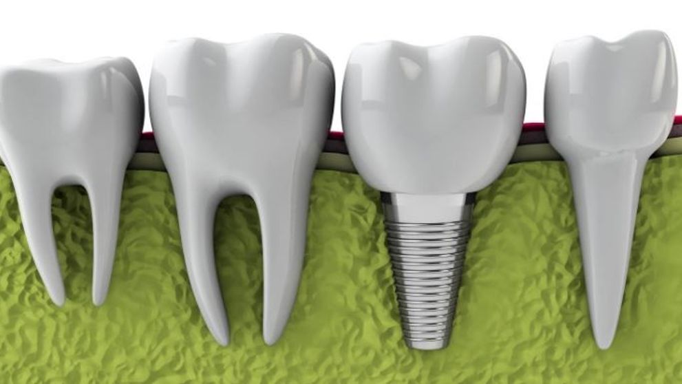 (P) Ce este, când ai nevoie și cum se face un implant dentar București?