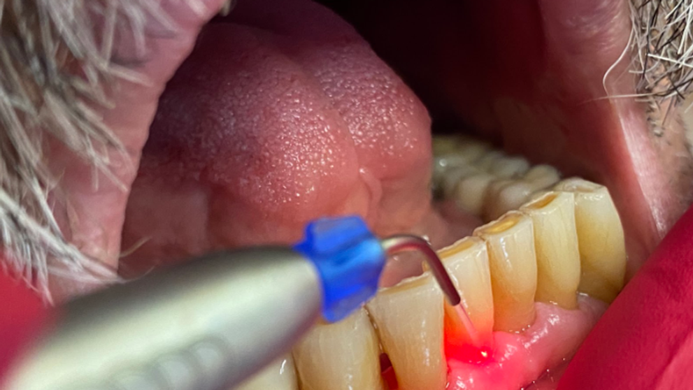 (P) Tratamentul parodontozei cu laserul – #LifeDentistii oferă 7 sfaturi pentru a preveni recidiva!