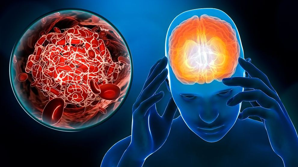 Accidentul Vascular Cerebral (AVC) - ce este și cum îl recunoaștem. Testul care își poate salva viața