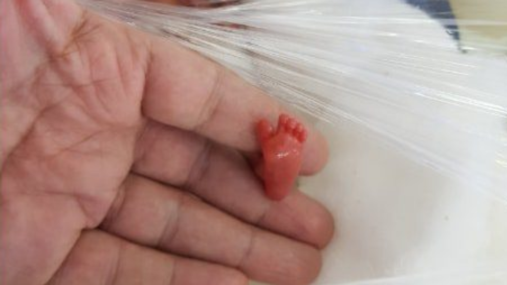 Cazul incredibil al unui bebelus nascut prematur la 12 saptamani