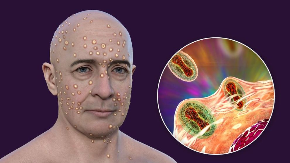 Variola maimuței (mpox), urgență de sănătate globală! Anunțul îngrijorător făcut de OMS