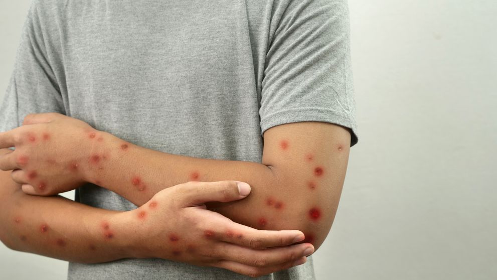 Cum te ferești de infectarea cu Mpox. Patru măsuri esențiale. OMS, în alertă după ce a fost confirmat primul caz în Europa