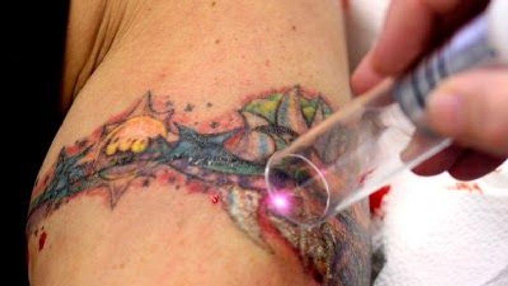 Ca un desen sters in Photoshop. Cum se indeparteaza cu laserul un tatuaj si cum arata pielea dupa aceea: VIDEO