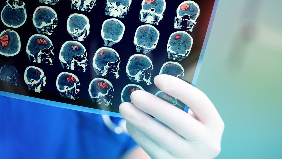 Și-a făcut un RMN pentru durerile de spate, dar medicii i-au descoperit o tumoare cerebrală. Simptomele banale pe care le-a ignorat o femeie de 38 de ani: „Am crezut că o să mor”
