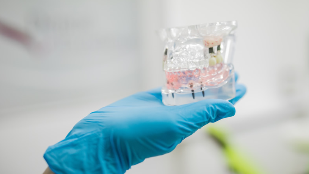 (P) Implanturile dentare pot necesita și adiție de os! Iată ce presupune această tehnică medicală!