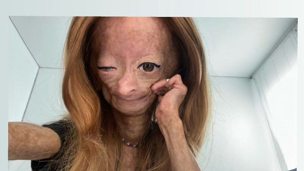 Adalia Rose, vedeta YouTube cu boala 