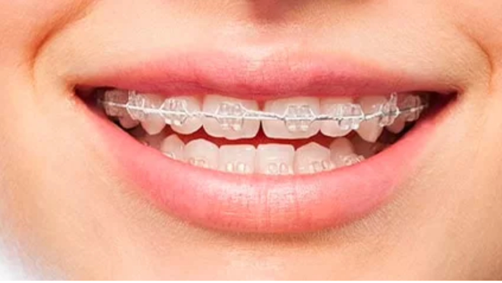 (P) Ai nevoie de un aparat dentar? Informează-te înainte!
