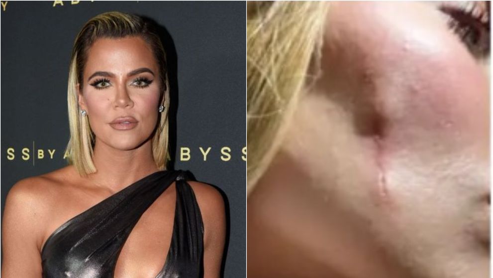 Khloé Kardashian, fotografie tulburătoare din lupta sa cu cancerul! Vedeta și-a îndepărtat tumora de la nivelul feței: „Mi-au schimbat chipul”. Cum arată acum