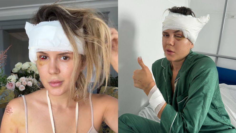 Primele declarații ale lui Emily Burghelea despre operația pe care a suferit-o. I-a fost montată o tijă la nivelul capului, iar recuperarea va fi una anevoioasă „Prima operație din viața mea”