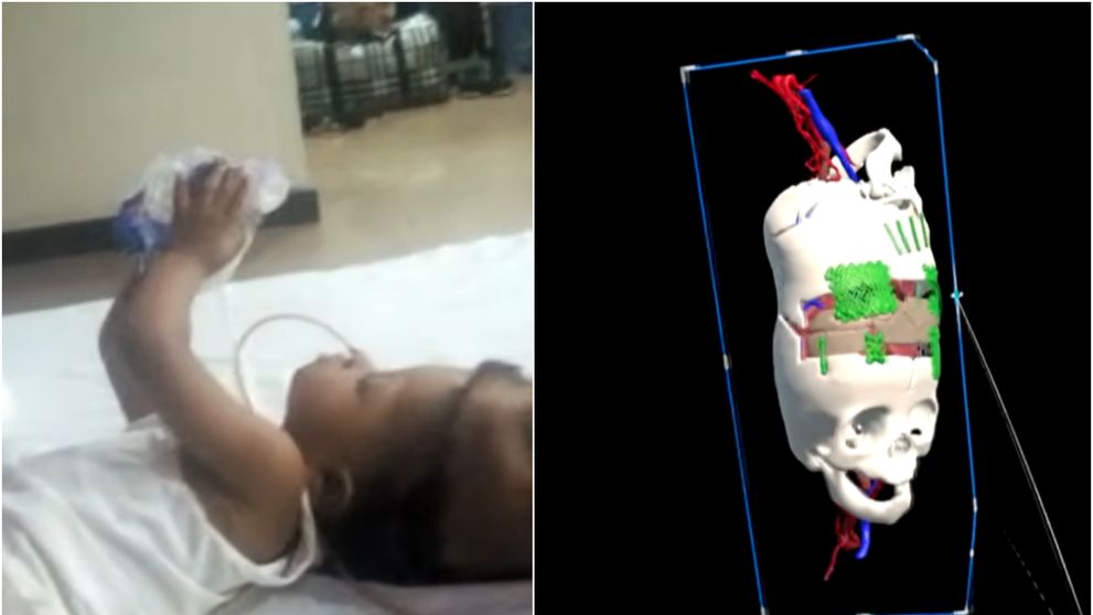 Gemene siameze cu craniile lipite, separate cu succes prin intervenții asistate de Inteligența Artificială. Cum arată acum fetele în vârstă de trei ani