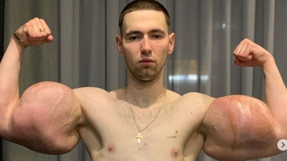 Popeye din Rusia, la un pas de moarte. Și-a scos implanturile din bicepși pentru a-și salva viața